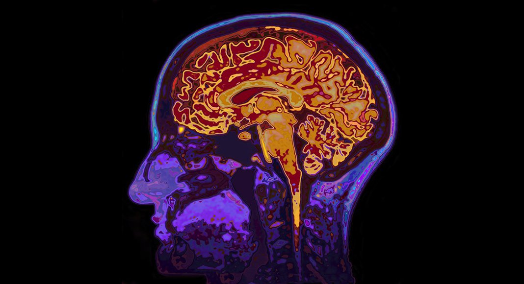 Subcortical brain volume differences in participants with attention deficit hyperactivity disorder in children and adults